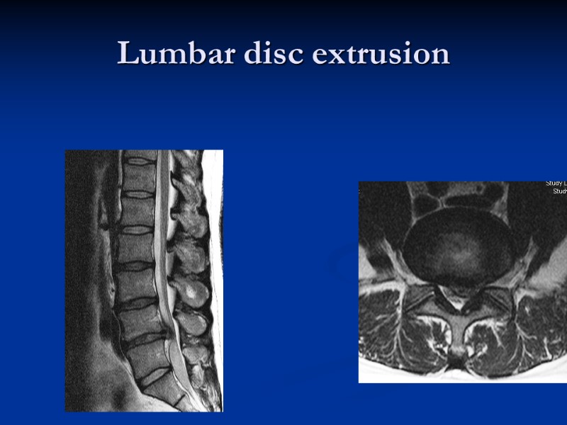 Lumbar disc extrusion